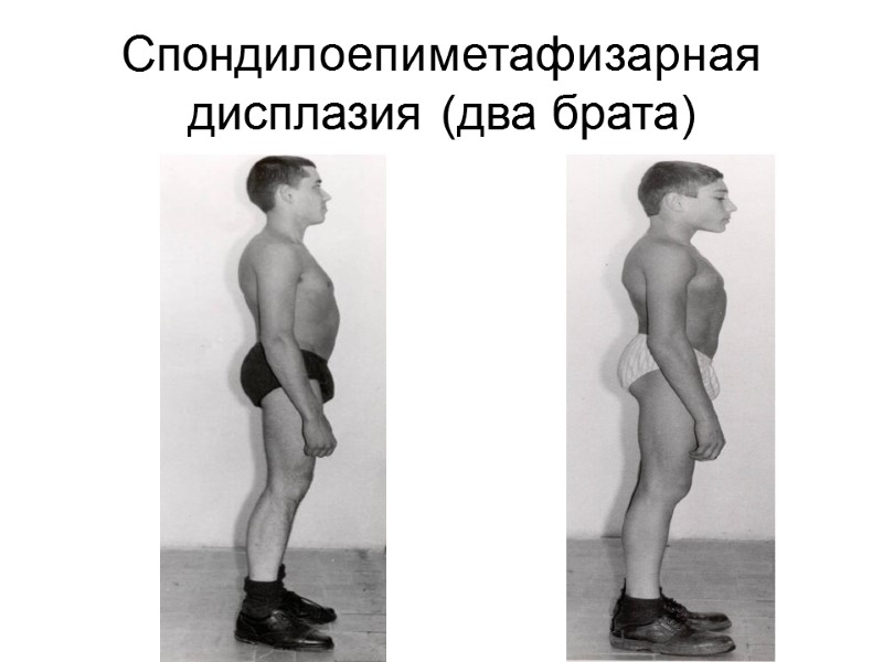 Спондилоепиметафизарная дисплазия (два брата)